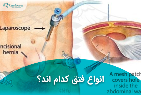 فتق چیست؟ انواع فتق کدام اند؟